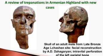 Что узнали армянские учёные о тайнах доисторических хирургов?