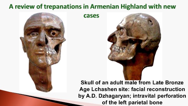 Что узнали армянские учёные о тайнах доисторических хирургов?