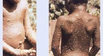 В Армении нет случаев заражения обезьяньей оспой. Министерство здравоохранения