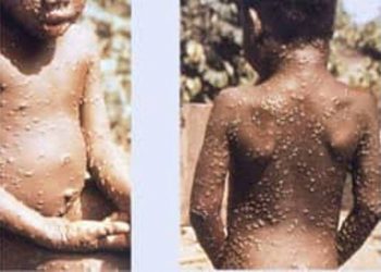 В Армении нет случаев заражения обезьяньей оспой. Министерство здравоохранения