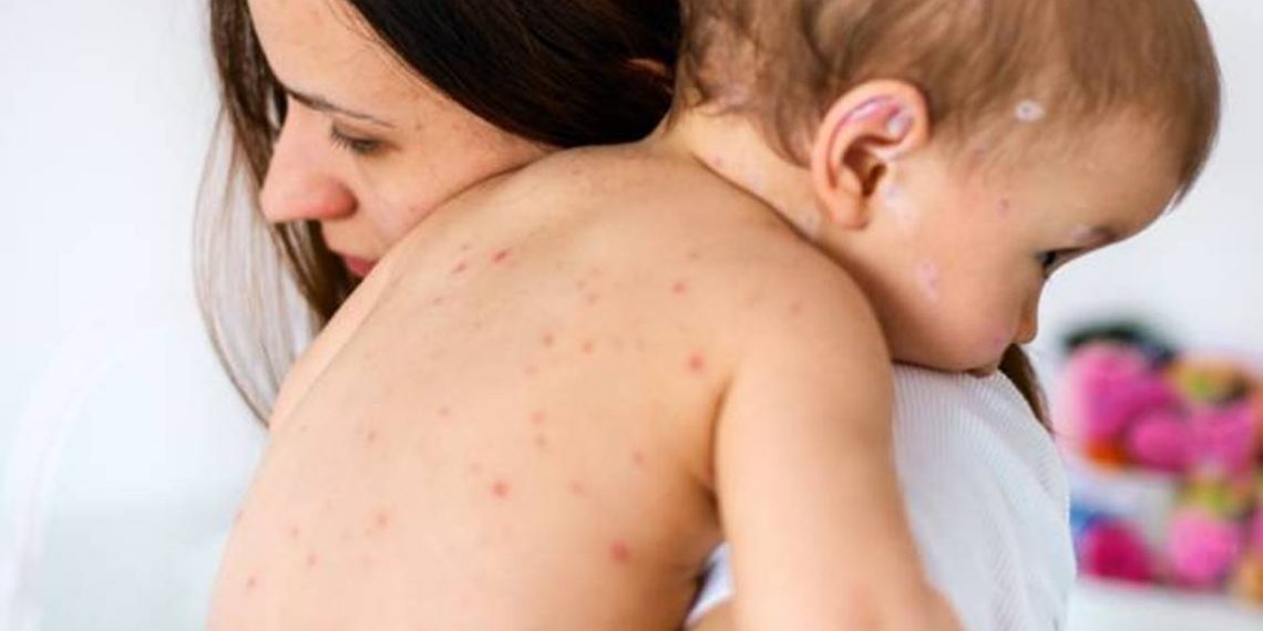 Число лабораторно подтвержденных случаев кори в Армении достигло 29, 15 заболевших госпитализированы