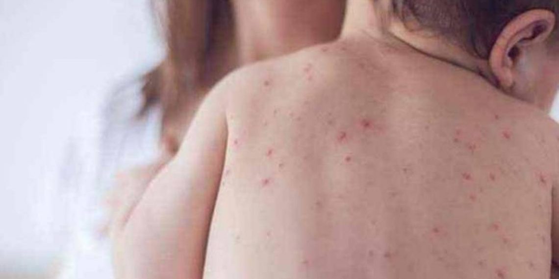 Число лабораторно подтвержденных случаев кори в Армении достигло 43: состояние двух заболевших оценивается как тяжелое