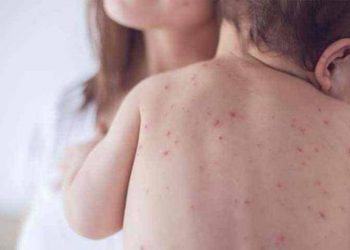 Число лабораторно подтвержденных случаев кори в Армении достигло 43: состояние двух заболевших оценивается как тяжелое