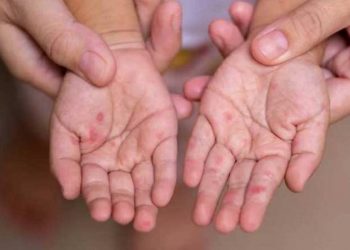 Число лабораторно подтвержденных случаев кори в Армении достигло 50